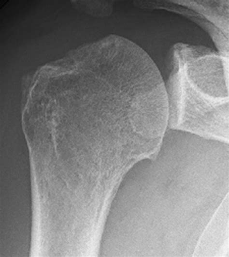 Preoperative Anteroposterior Radiograph Download Scientific Diagram