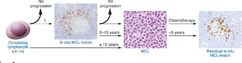 Figure 1 From Molecular Pathogenesis Of Mantle Cell Lymphoma