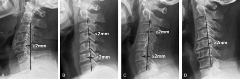 Toyama Classification Of Cervical Sagittal Alignment Lordosis A Download Scientific Diagram