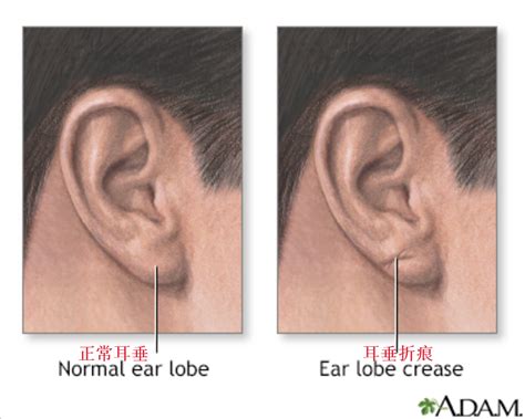 What Is Earlobe Creasewhat Is The Relationship Between Earlobe Folds