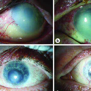 Anterior Segment Photography A Left Eye At Presentation Note The