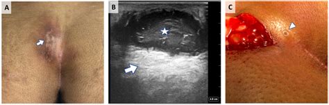 Infected Pilonidal Abscess