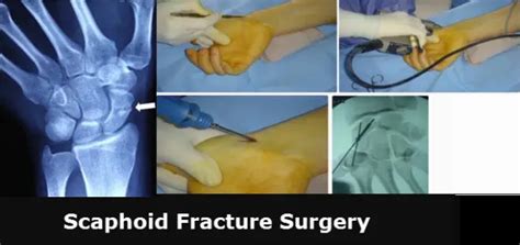 Scaphoid Bone Fracture Surgery