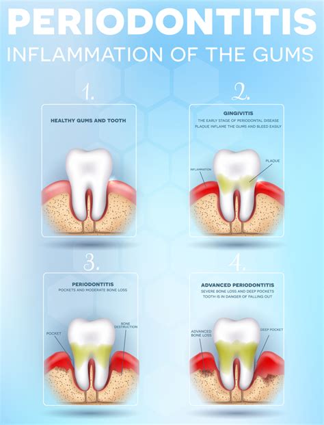 Celebrate National Gum Care Month and Avoid Gum Disease