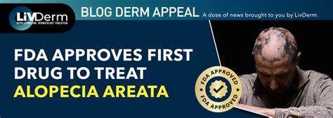 Fda Approves First Drug To Treat Alopecia Areata Livderm