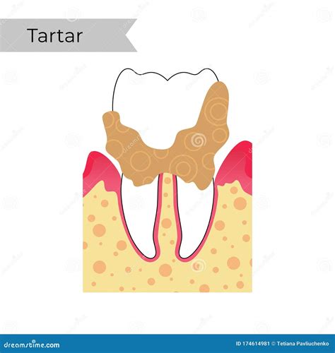 Tartar Or Calculus Teeth Illustration Vector On Blue Background