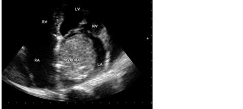 Left Atrial MyxomaA Case Report