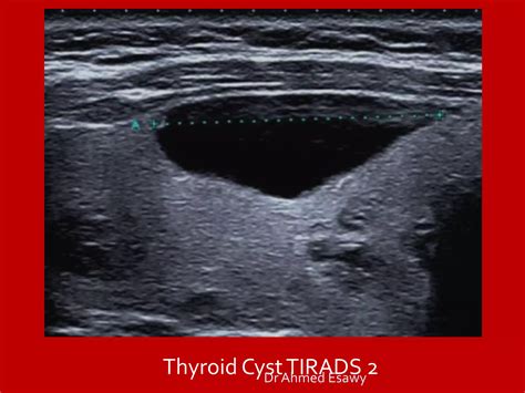 Tirads Thyroid Nodule Imaging Reporting And Data System Dr Ahmed