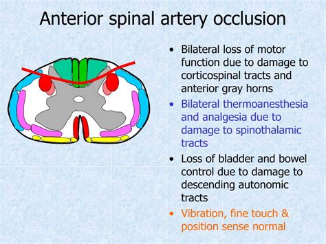 Anterior Spinal Artery Occlusion