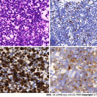 Histological And Immunohistochemical Images Of Merkel Cell Carcinoma