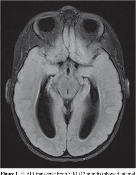 Figure 1 From Infantile Alexander Disease With Late Onset Infantile