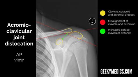 Shoulder X Ray Interpretation Radiology Geeky Medics