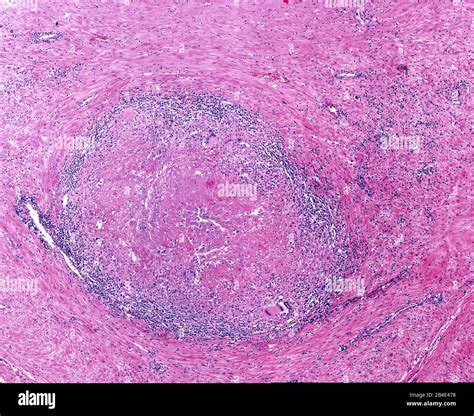 Tuberculosis granuloma with a central necrosis (caseous necrosis ...