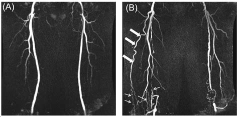 Examples Of Magnetic Resonance Angiogram Mra Images From A A