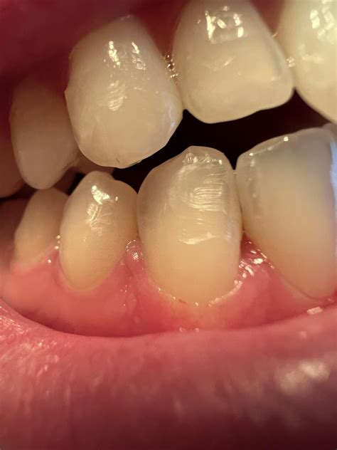 Enamel Damage After Invisalign Debonding Raskdentists