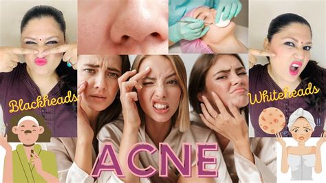 Acne Blackheads Whiteheads Kya Hai Cause Of Pimples Or Acne How We