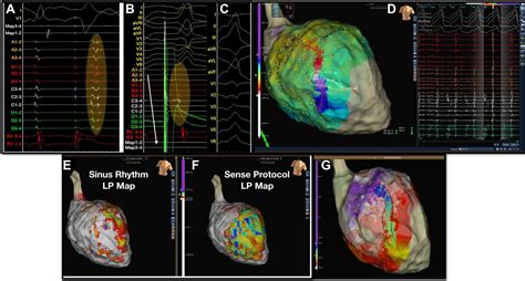 The Value Of Functional Substrate Mapping In Ventricular Tachycardia Ablation Heart Rhythm O2