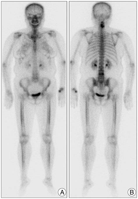 Whole Body Bone Scan A Anterior B Posterior Shows An Amorphous