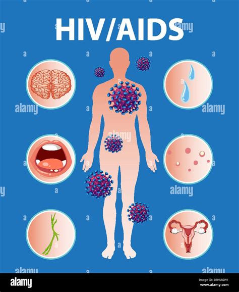 Illustration Depicting How Hivaids Virus Attacks Immune System And Affects Brain Mouth And