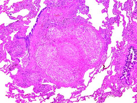 My Approach To Interstitial Lung Disease Using Clinical Radiological