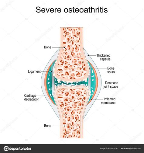 Severe Osteoarthritis Synovial Joint Bone Spurs Inflamed Membrane