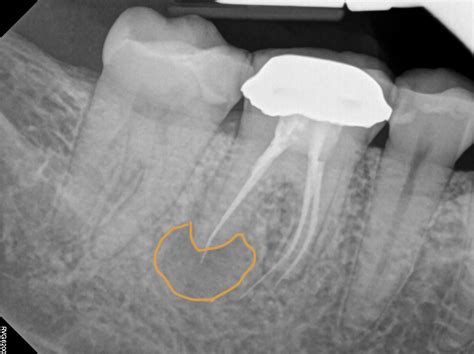 The Bad Side Of Root Canals Making An Informed Decision — Celery And The City