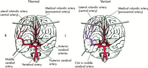 Middle Cerebral Artery Territory Infarction Sparing The Precentral