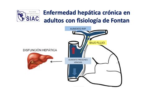 Enfermedad hepática crónica en adultos con fisiología de Fontan