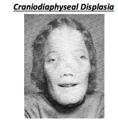 Craniodiaphyseal Dysplasia Skull