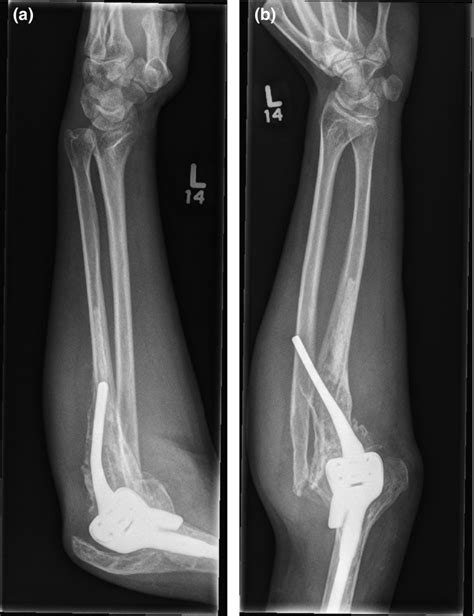 Radius And Ulna X Ray