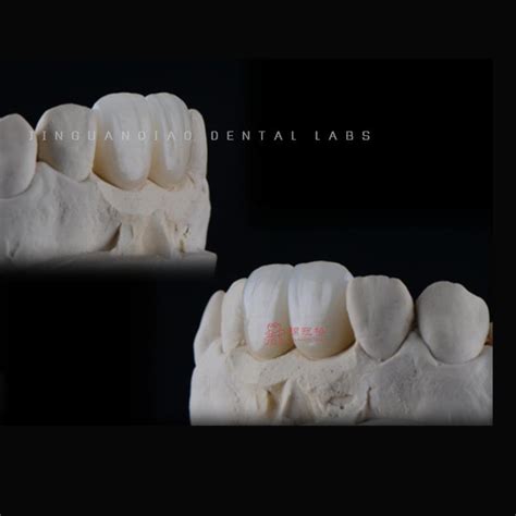 D Printed Dental Restorations Zircornia Crowns And Denture Porcelain