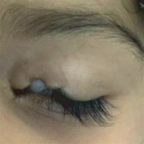 Incomplete Form Of Cryptophthalmos Where The Lower Eyelid Is Present