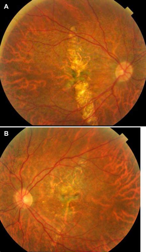 Fundus Photographs Of The Right A And Left B Eyes Months After