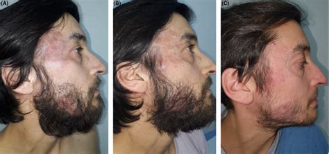 Primary Cutaneous Cd Positive Small Medium Tcell Lymphoproliferative