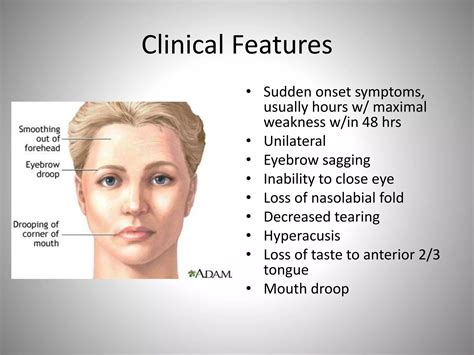 Facial Palsy Ppt