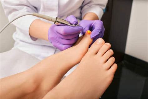 Laser Treatment For Nail Fungus Minimally Invasive Nyc