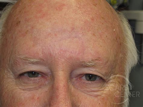 Forehead Reconstruction 4 - Skin Cancer and Reconstructive Surgery Center