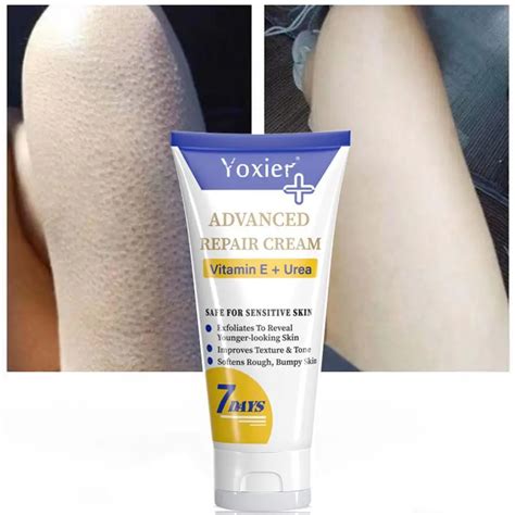 50g Curing Keratosis Pilar Repair Cream Remove Chicken Skin Dark Spots Moisturizing Smooth Pores