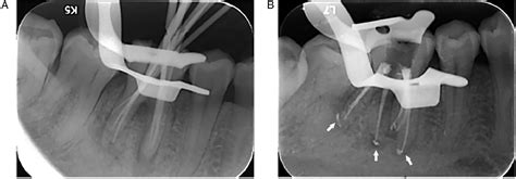 Figure 5 From Endodontic Treatment Of The Mandibular First Molar With