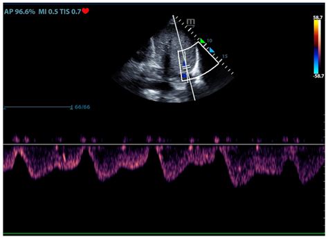 The Ultrasound Sign Of Hepatic Venous Excess Waveform Download Scientific Diagram