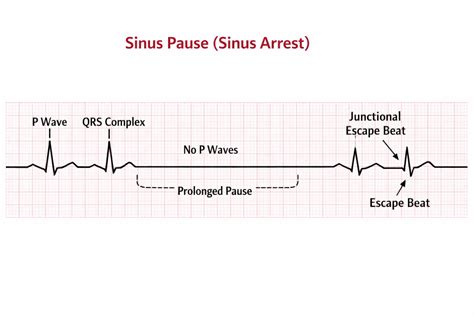 sinus pauses icunotes
