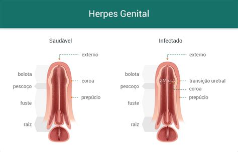 HERPES GENITAL O QUE É SINTOMAS TRATAMENTOS Jogue na Fortune