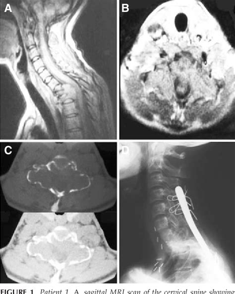 Figure 1 From Giant‐cell Tumors Of The Cervical Spine Case Report Semantic Scholar