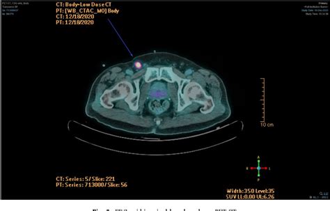 Figure 3 From Contemporary Management Of Inguinal Lymph Nodes In Squamous Cell Carcinoma Of The