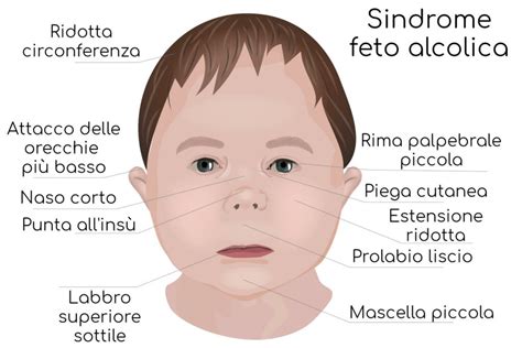 Patologia Fetale Da Abuso Di Alcol