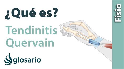 Tendinitis De De Quervain Qu Es Youtube