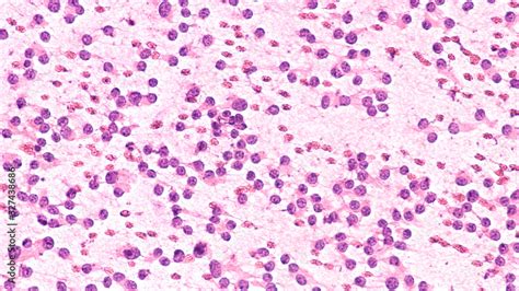 Squash Prep Cytology Smear Of A Pituitary Adenoma A Benign Tumor Of