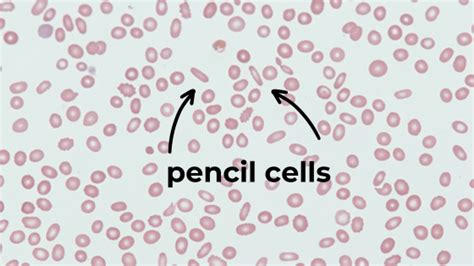 Iron Deficiency Anaemia Dont Forget The Bubbles