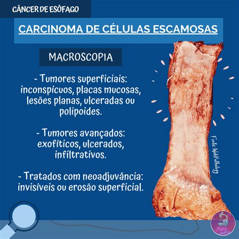 Câncer de Esôfago Carcinoma de Células Escamosas PathoLovers