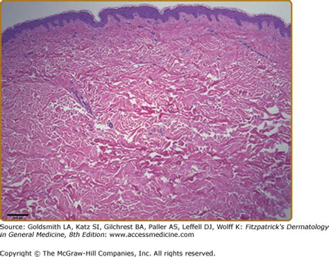 Tuberous Sclerosis Complex | Plastic Surgery Key